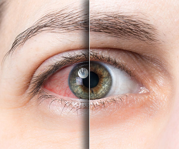 Trockene Augen - Ursachen, und Risikofaktoren | Optik Müller